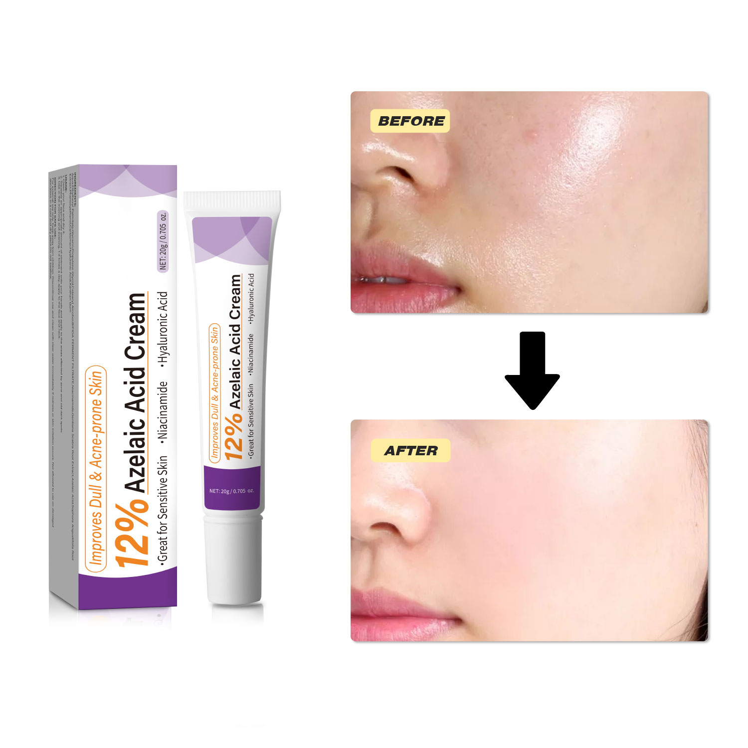 Mild Azelaic Acid Cream Improv - Azelaic Acid Cream review and price